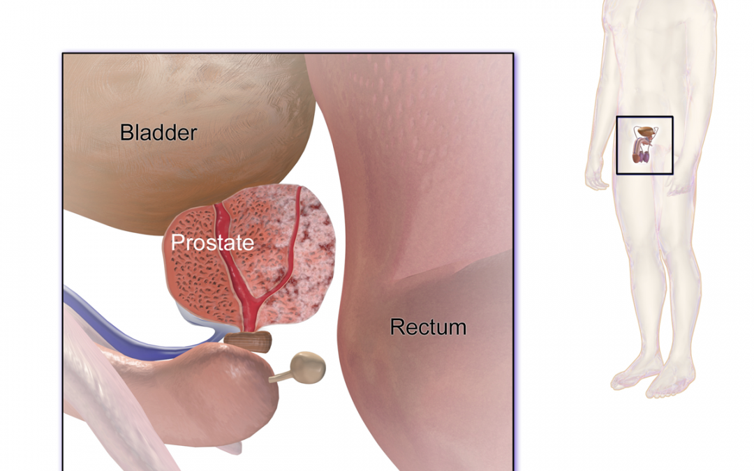 Cancer de la prostate : un test pour calculer son risque
