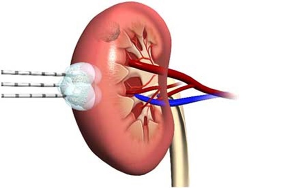 Indications de la cryothérapie pour les cancers du rein
