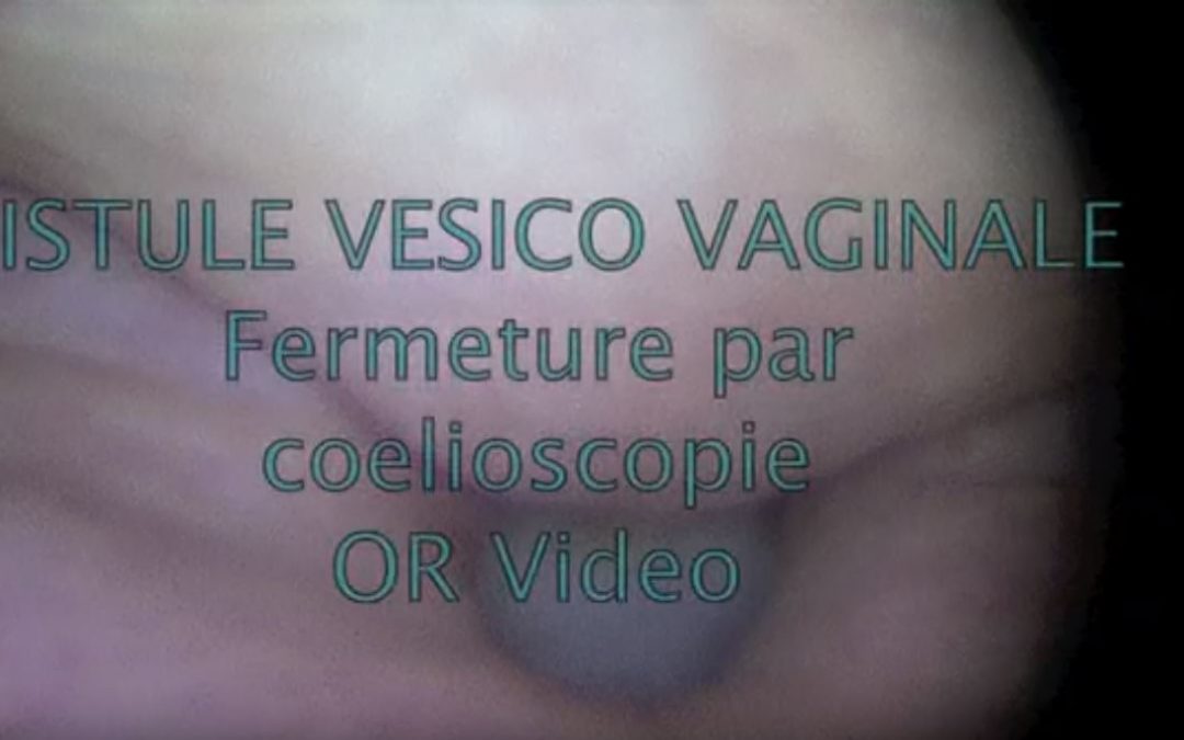 Fistule vésico-vaginale : fermeture par coelioscopie
