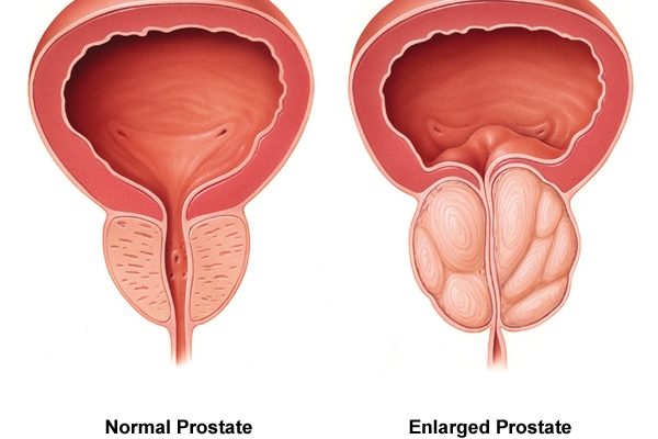Quels sont les facteurs de risque de l&rsquo;adénome de la prostate ?