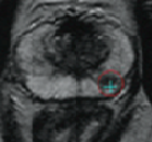 Zones suspectes biopsie prostate