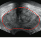 Méthode de contourage morphologique de la prostate