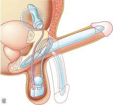 cancer prostate implants péniens