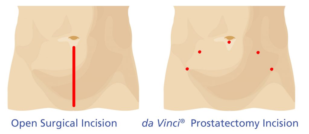 Incision_trocarts_Prostatectomy