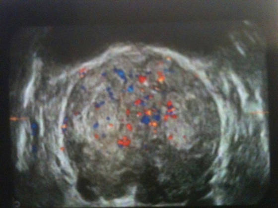 Un adénome de la prostate de moyen volume avec étude doppler portant sur la partie centrale adénomateuse.