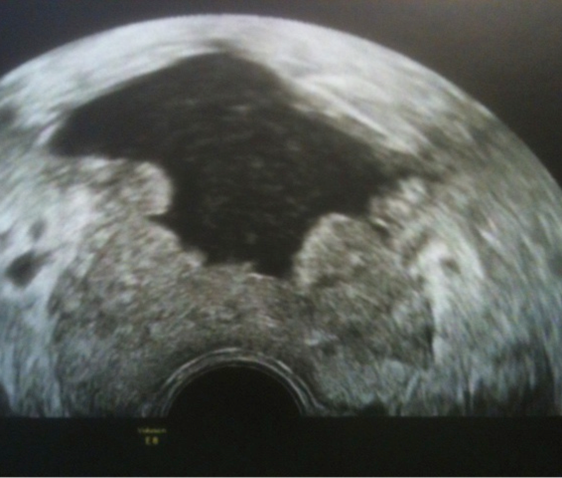 Echographie après énucléation au laser Holmium de l’adénome central