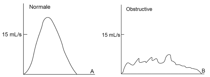 Example d'examen de débimétrie normale et obstructive
