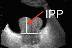 Volumineux lobe médian prostatique avec IPP de grade 3