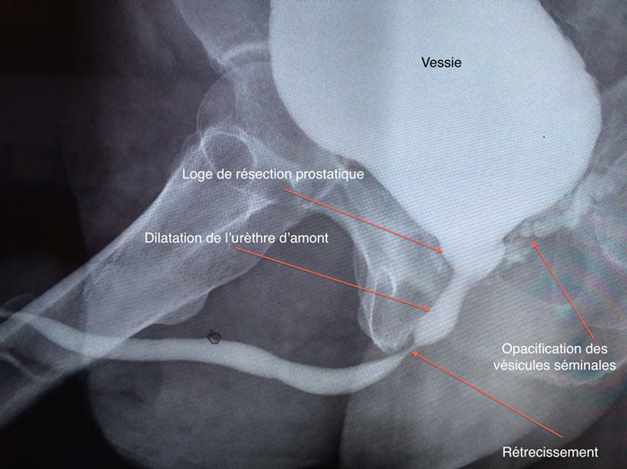 Rétrécissement postérieur de l’urètre bulbaire