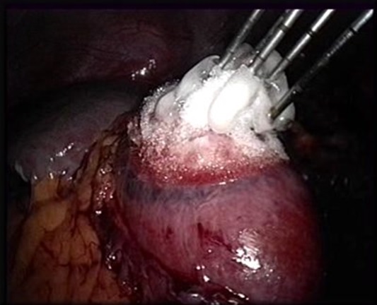 Cryoablation par voie laparoscopique