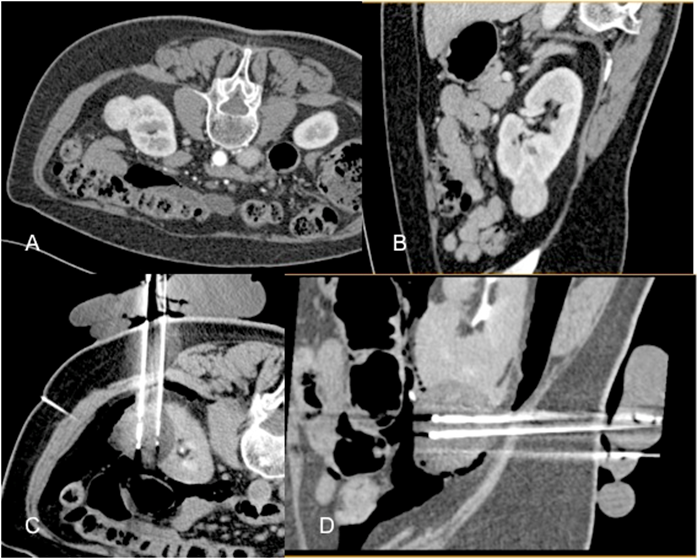 Cyoablation par voir per cutanee