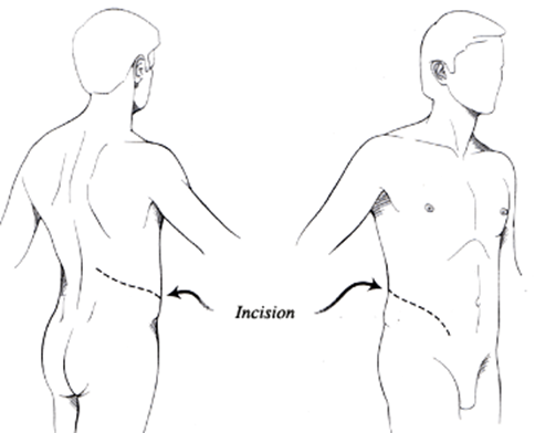 Incision résection-suture de la jonction pyelo urétérale