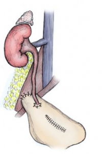 La réimplantation de l’uretère dans une vessie psoique