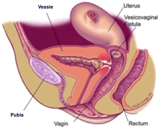 La fistule vésico-vaginale