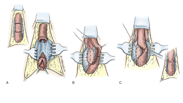 Technique de résection-suture de l’urètre