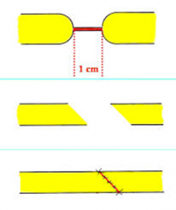 Uretroplastie résection – suture