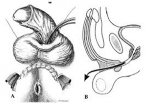 uréthroplastie avec patch en deux temps