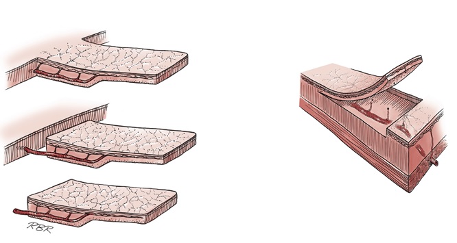 Apport du lambeau de muqueuse buccale à la chirurgie reconstructrice de l’urètre