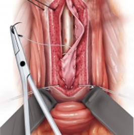 Suturation du tissu spongieux