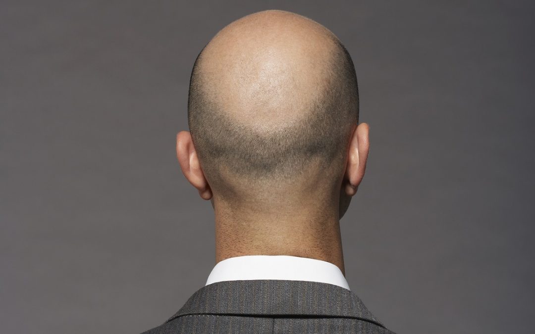 Cancer de la prostate et calvitie : le lien se confirme