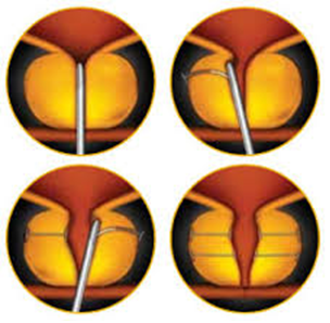 implants intra prostatique