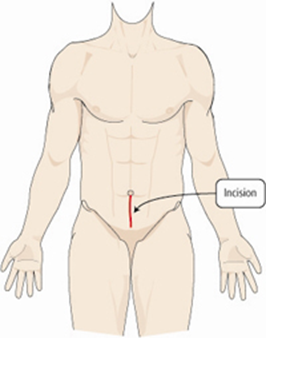 Incision hypertrophie adénomateuse de la prostate 