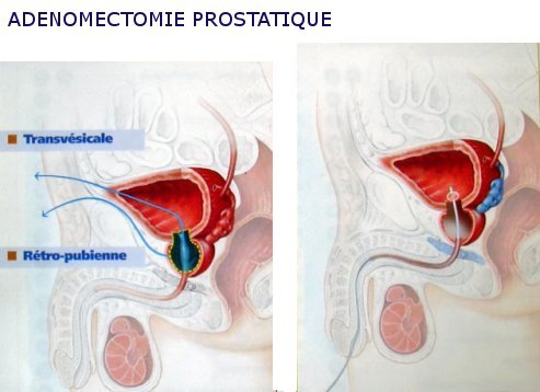 adenomectomie-top-image