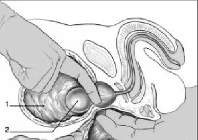 enucleation prostate doigt