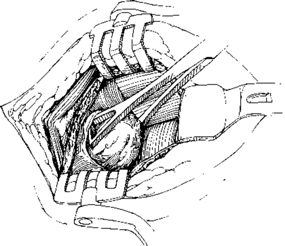 Adénomectomie chirurgicale classique à ciel ouvert 