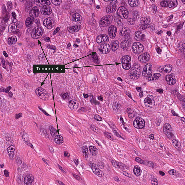 Le carcinome urothélial ou carcinome à cellules transitionnelles
