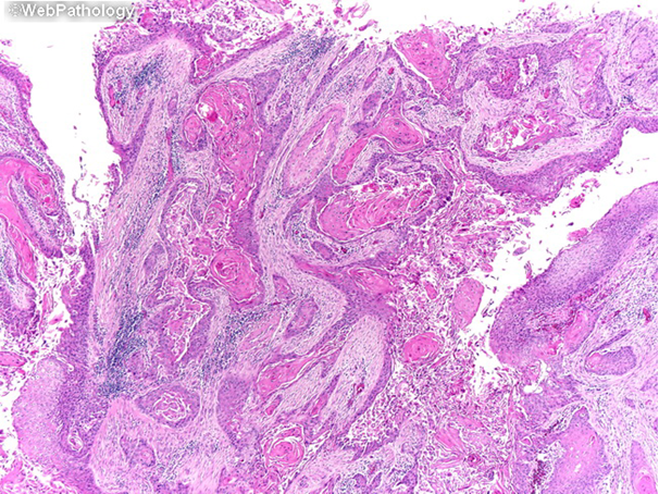 Le carcinome à cellules malpighiennes