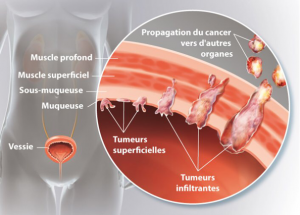 Propagation du cancer de la vessie