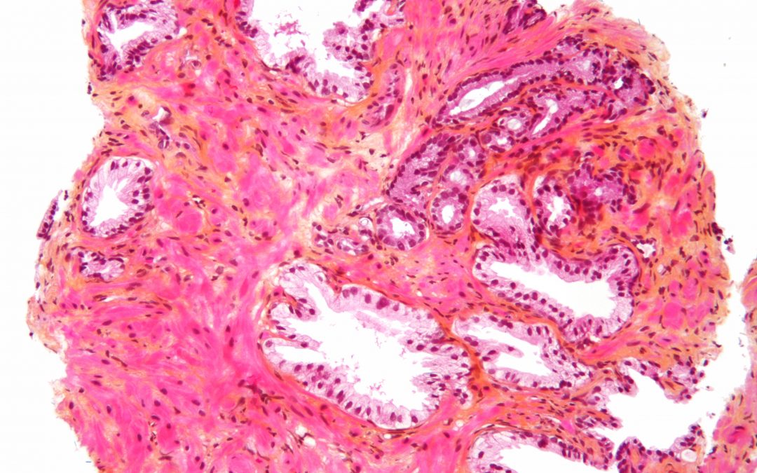L’importance du diagnostic précoce du Cancer de la prostate à faible risque