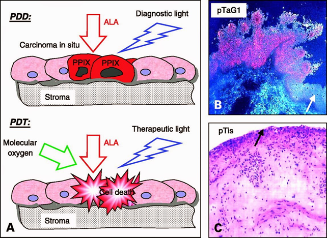 Thérapie photo dynamique