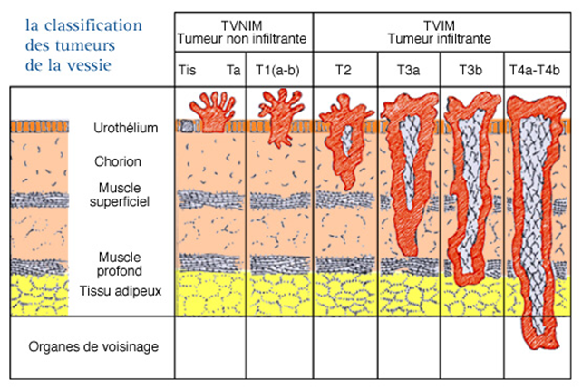 La classification des tumeurs de vessie
