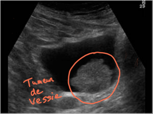 Tumeur de la vessie