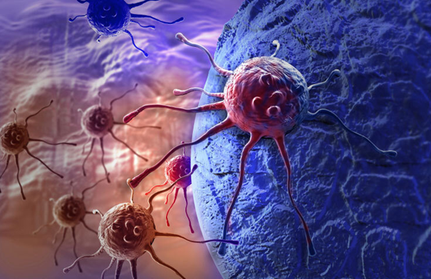 Les Principes Du Traitement Du Cancer De La Vessie