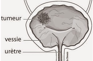 Complications, Risques et Séquelles de la cystectomie