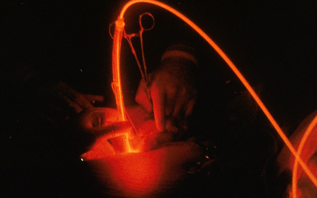 Nouvel espoir pour les cancer de la prostate à bas risque avec la thérapie photodynamique à visée vasculaire