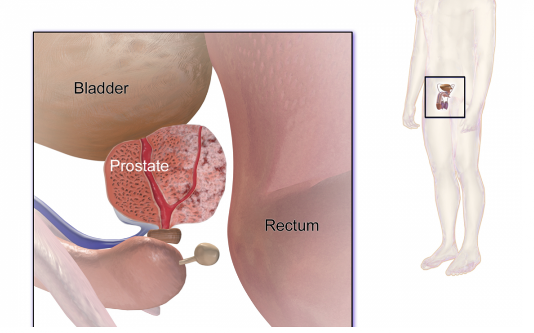 Les techniques d&rsquo;irradiation du cancer de la prostate.