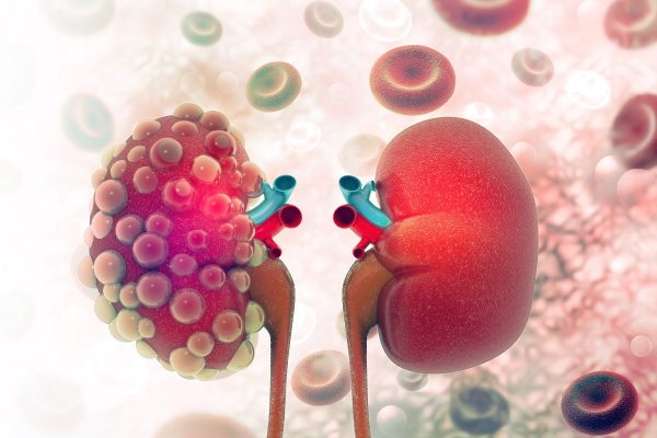Régime alimentaire spécifique au cancer du rein : Les aliments à privilégier et ceux à éviter