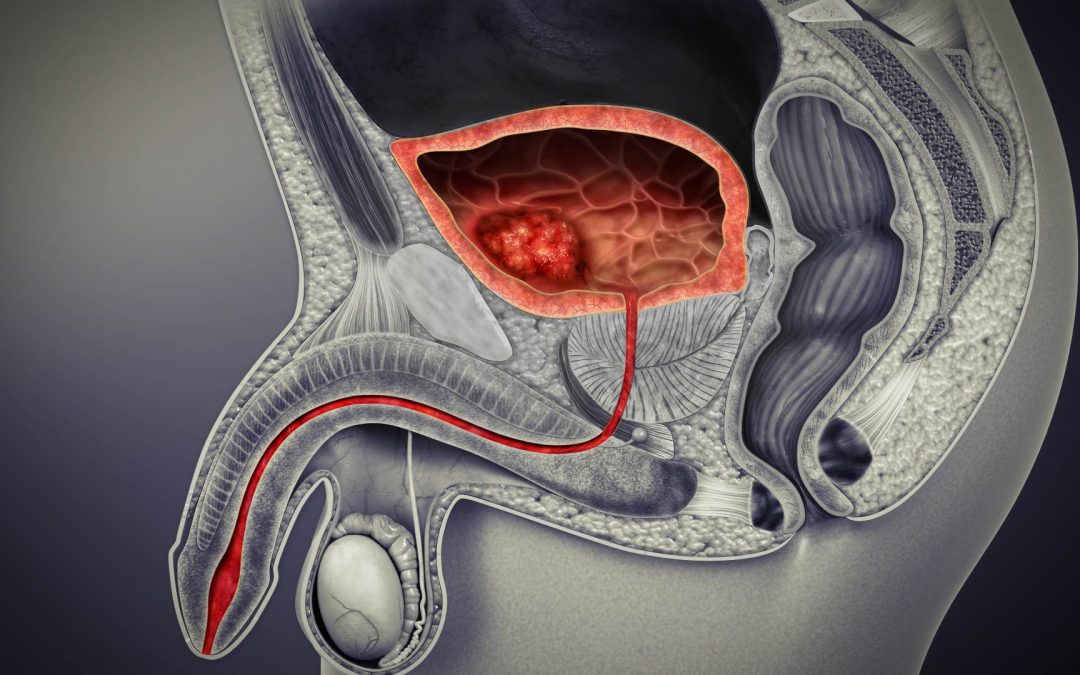 Cancer de la vessie : un meilleur pronostic des formes avancées grâce à l’immunothérapie