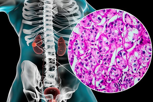 Une triple thérapie identifiée pour le traitement du cancer du rein