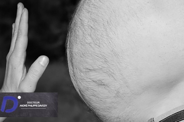 L’obésité augmente le risque de cancer de la prostate