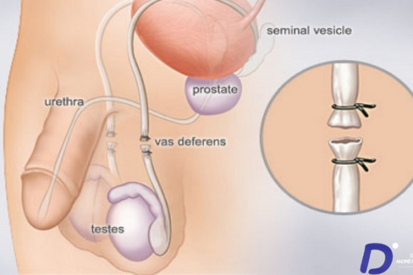 Vasectomie : La contraception masculine