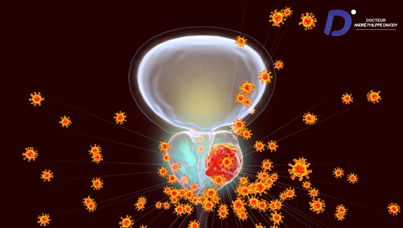 risque cancer prostate suite vasectomie