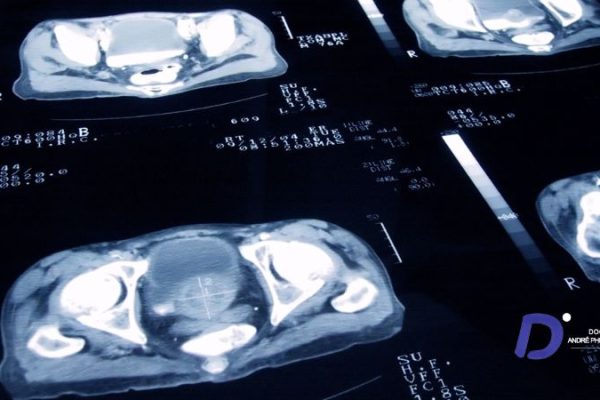 Cancer de la prostate oligométastatique : un nouveau traitement combiné pour les patients