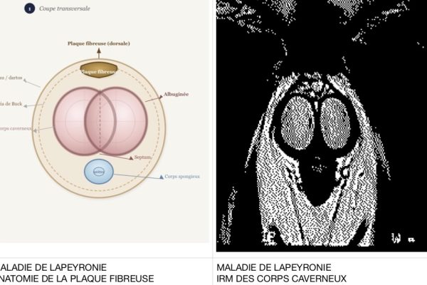 Perovial® et acide hyaluronique dans la maladie de La Peyronie
